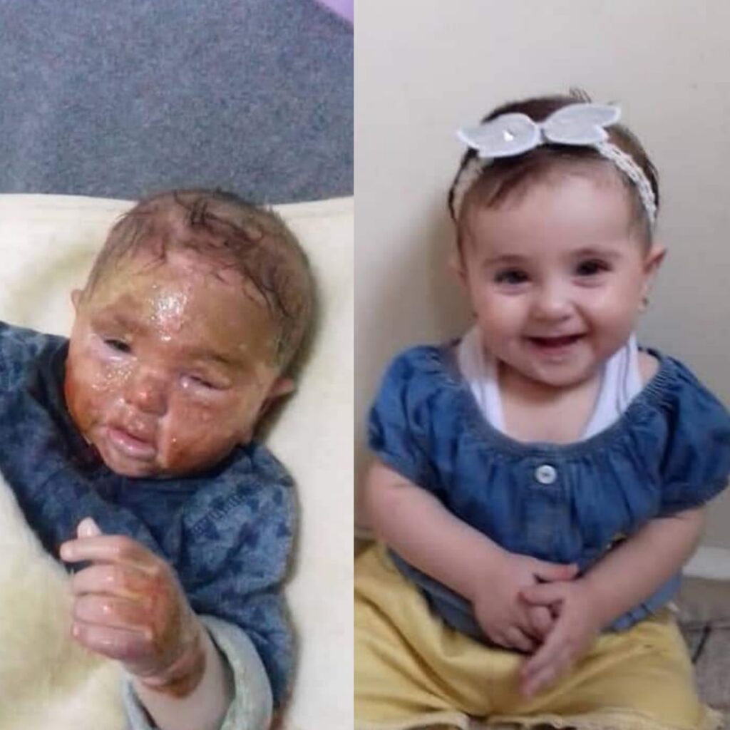صورة الطفلة المصابة بحروق من الحسكة السورية وليست من تعز اليمنية